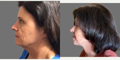 Deep Plane Facelift before and after photo