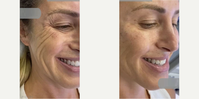 Dysport before and after photo