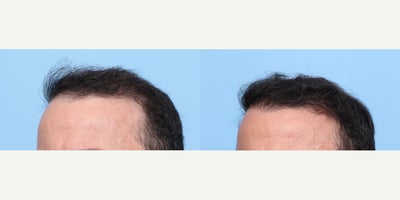 Hair Loss Treatment before and after photo