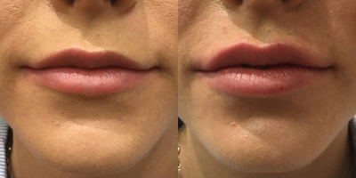 Lip Fillers before and after photo