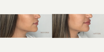 Lip Fillers before and after photo