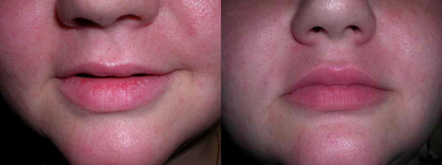Botox before and after photo
