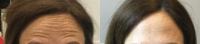 Botox before and after photo