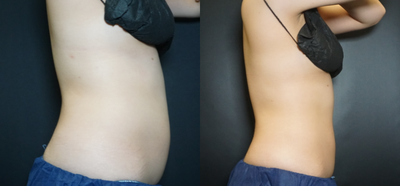 CoolSculpting before and after photo