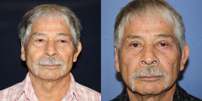Eyelid Surgery before and after photo
