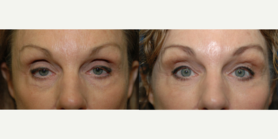 Facial Fat Transfer before and after photo