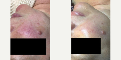 IPL before and after photo