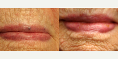 YAG Laser before and after photo
