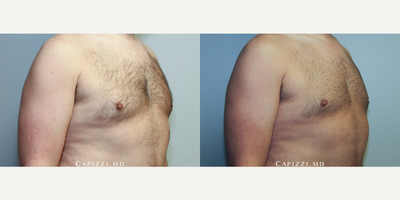 CoolSculpting before and after photo