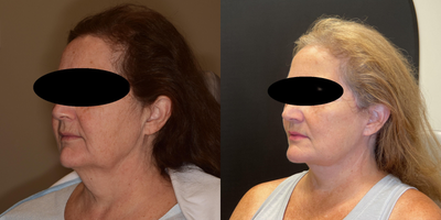 Deep Plane Facelift before and after photo