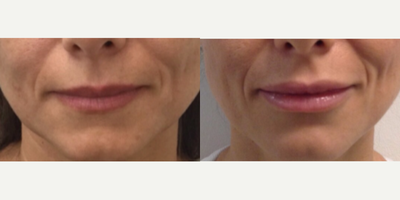 Dermal Fillers before and after photo