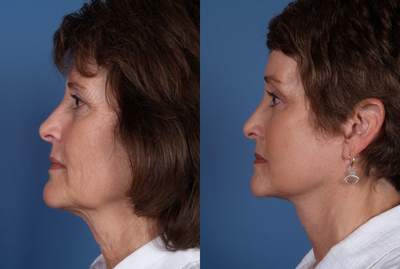 Facelift before and after photo
