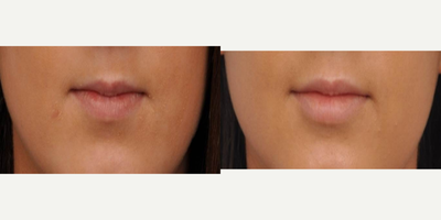 Lip Fillers before and after photo