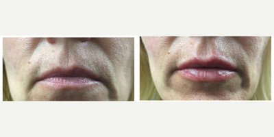 Lip Fillers before and after photo