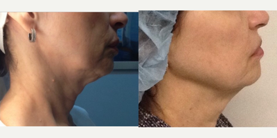 Pelleve before and after photo