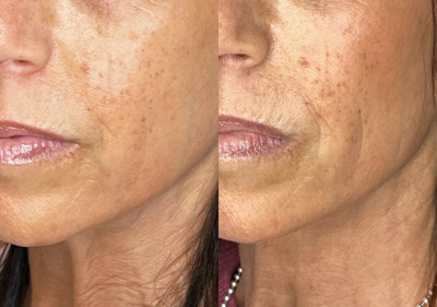 Sofwave before and after photo