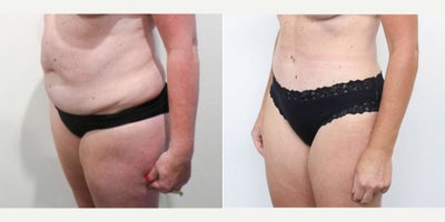 Tummy Tuck before and after photo