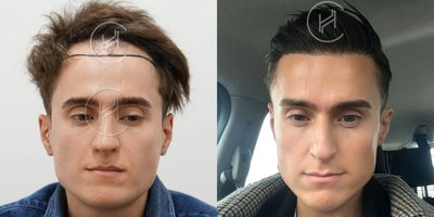 FUE Hair Transplant before and after photo
