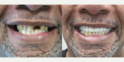 All-on-4 Dental Implants before and after photo