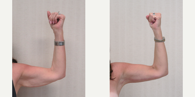Arm Lift before and after photo
