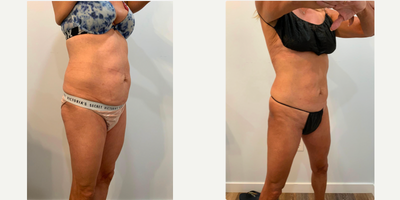 BodyTite before and after photo
