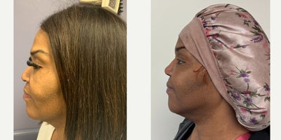 Brow Lift before and after photo