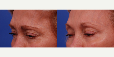 Dysport before and after photo