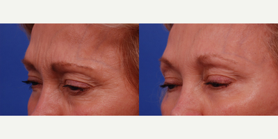 Dysport before and after photo