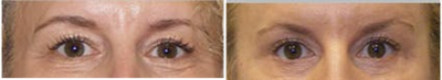 Eyelid Surgery before and after photo