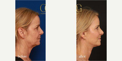 Facelift before and after photo