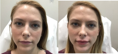 Lip Fillers before and after photo