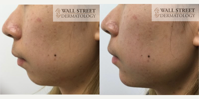 Restylane before and after photo