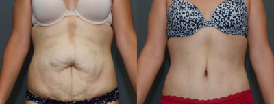 Tummy Tuck before and after photo