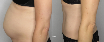 Tummy Tuck before and after photo