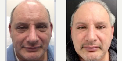 Botox before and after photo
