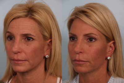 Brow Lift before and after photo