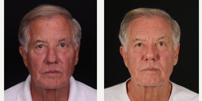 before and after image