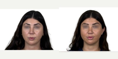 Lip Lift before and after photo