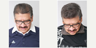 Scalp Micropigmentation before and after photo