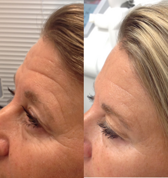 Botox before and after photo