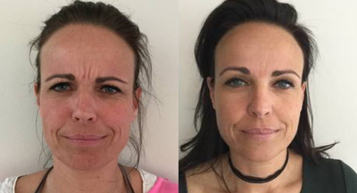 Botox before and after photo