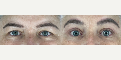 Brow Lift before and after photo