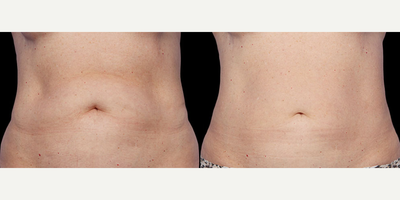 CoolSculpting before and after photo