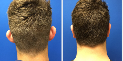 Ear Surgery before and after photo