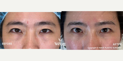 Eyelid Surgery before and after photo