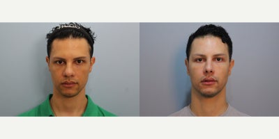 Facelift before and after photo