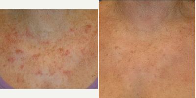 Laser Resurfacing before and after photo