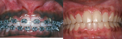 Smile Makeover before and after photo