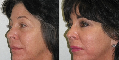 Dermal Fillers before and after photo