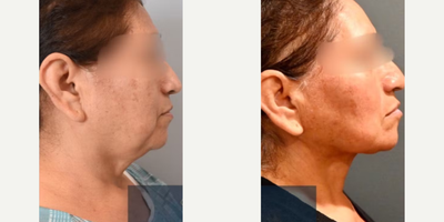 Facelift before and after photo